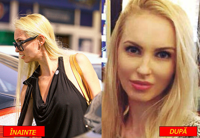 Andreea Spătaru, înainte şi după tratamentul împotriva acneei.