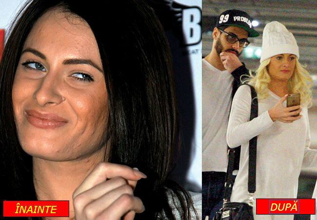 Raluka,  înainte şi după tratamentul împotriva acneei.