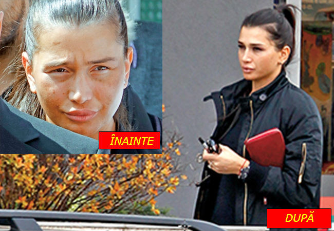 Elena Băsescu,  înainte şi după tratamentul împotriva acneei.