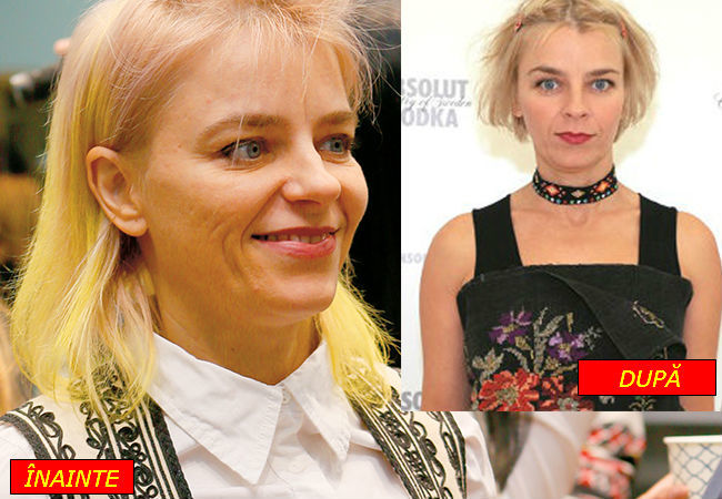 Gianina Corondan,  înainte şi după tratamentul împotriva acneei.