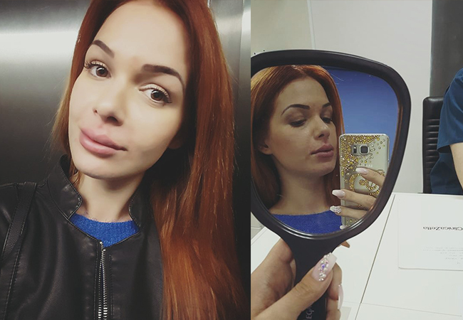 Aşa arată Deea Maxer după ce şi-a mărit buzele.