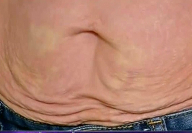 Adina Bourceanu a slăbit 40 de kilograme şi i s-a lăsat pielea.