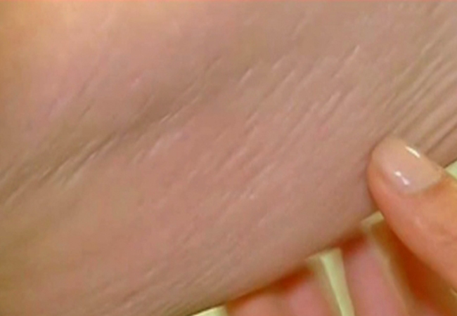 Adina Bourceanu a slăbit 40 de kilograme şi i s-a lăsat pielea.