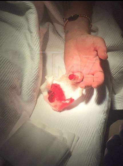 Medicii au reuşit să îi ataşeze la loc degetul sfârtecat al vedetei
