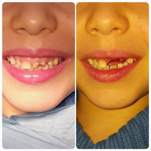 Fiul lui Dinu Maxer are probleme cu dantura