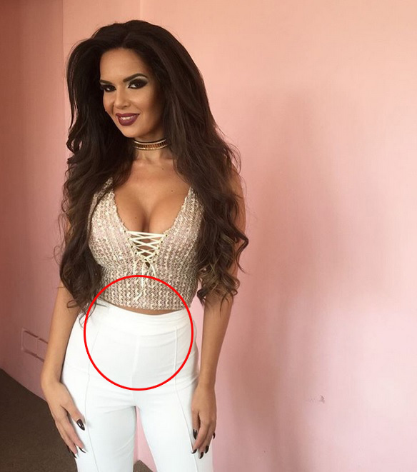 Iubita lui Lazarus are burtică.