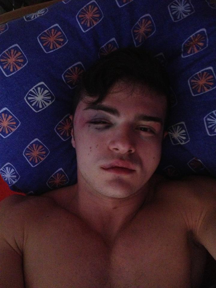 Dupa ce a fost batut la iesirea din club, Razvan are mai multe vanatai pe fata si corp