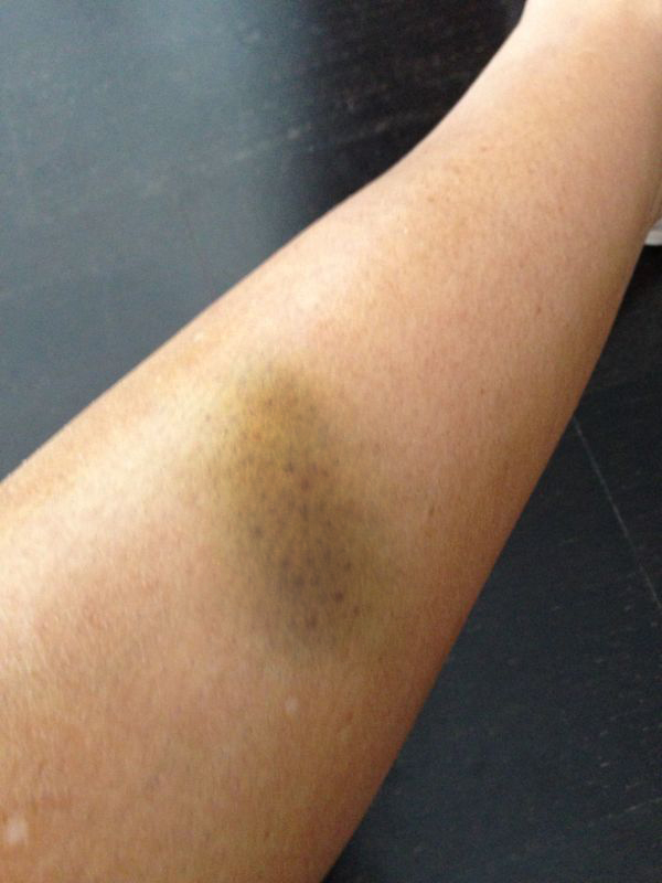 In urma unei altercatii din club, Flore s-a ales cu o vanataie in toata regula pe picior