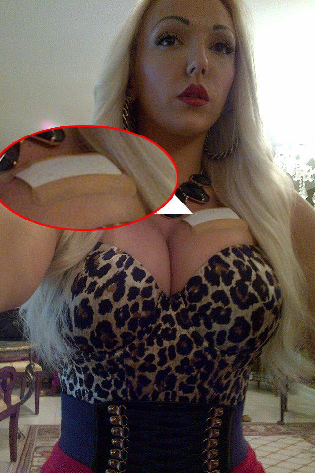 Bandajul acopera tatuajul pe care a inceput sa-l scoata