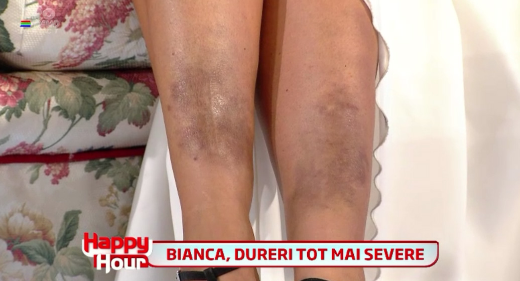 Asa arata picioarele Biancai dupa trauma suferita