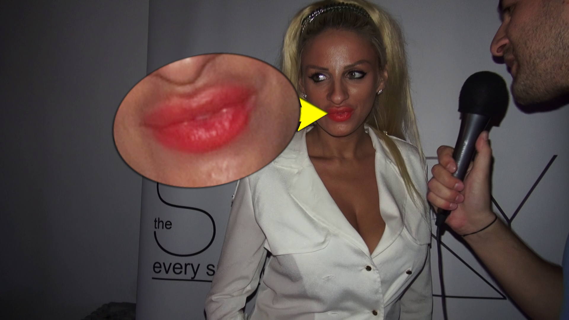 Multe injectii cu acid hialuronic au facut ca buzele blondei sa capete o forma ciudata