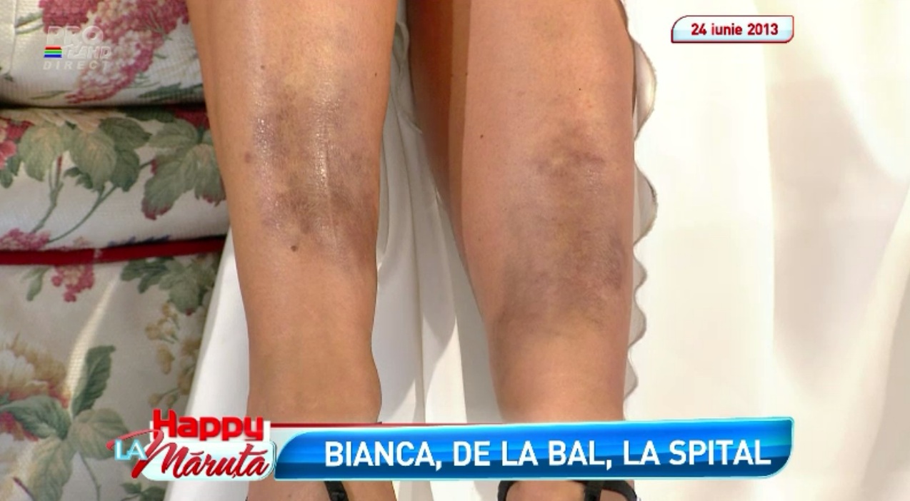 Bianca are probleme teribile cu picioarele din cauza loviturilor repetate aplicate de un fost iubit si pana acum a tot amanat tratamentul chirurgical