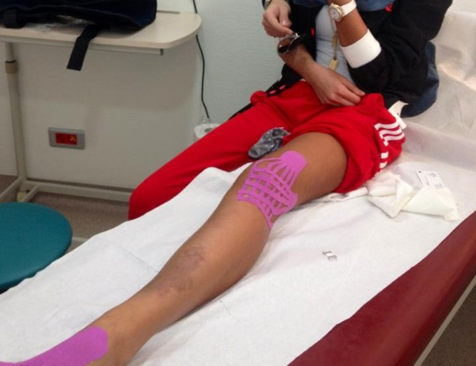 De când a fost bătută de fostul ei iubit, Coco Păun, Bianca a rămas cu vânătăi dureroase pe picioare