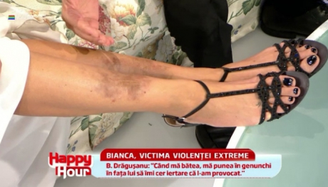 Picioarele Biancai au fost ani de zile brazdati de semne produse de loviturile nemiloase ale unui fost iubit