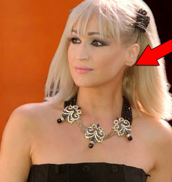 Simona Florescu si-a operat lobul urechii stangi