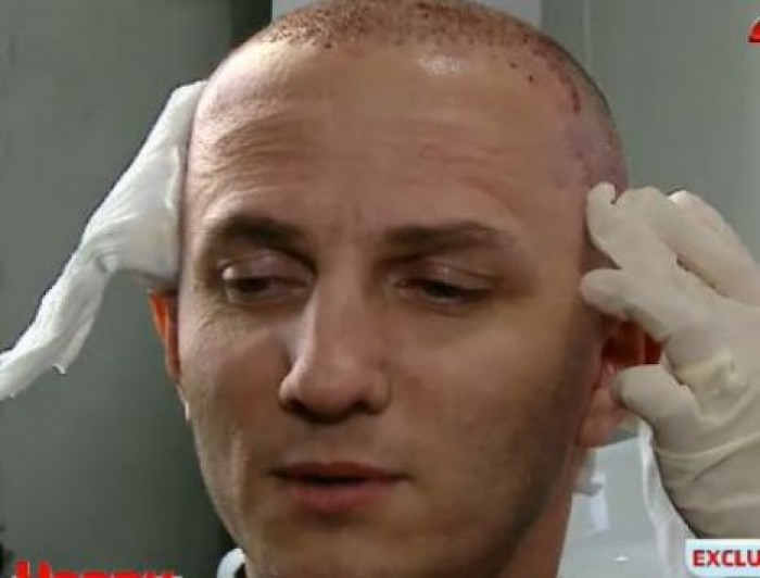 Mihai Traistariu si-a facut implant in 2013