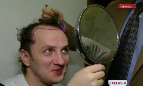 Mihai Traistariu, inainte de implantul de par