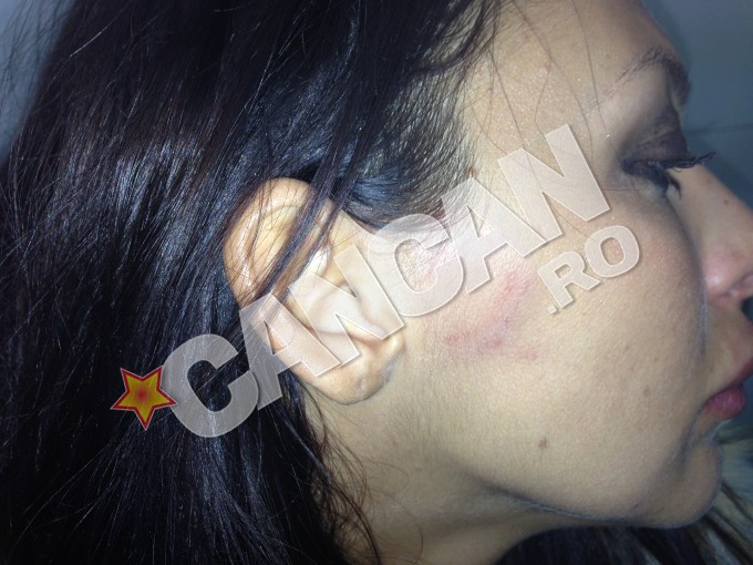 Bianca a declarat ca a fost muscata de Catalin intr-o criza de gelozie