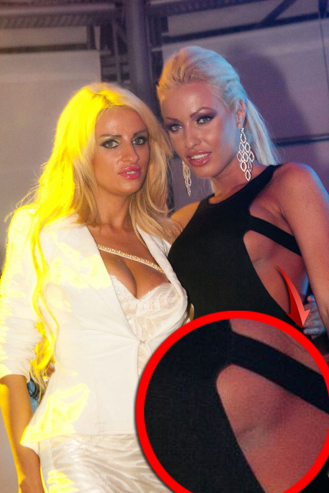 Desi a suferi doua interventii chirurgicale, Chivu nu a putut scapa de semnele inestetice