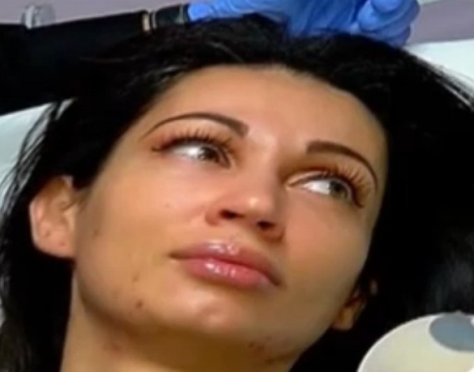 In urma cu doua luni, Nicoleta s-a trezit cu fata invadata de acnee