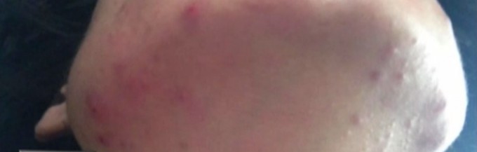 Se pare ca acneea Nicoletei a avut cauze hormonale