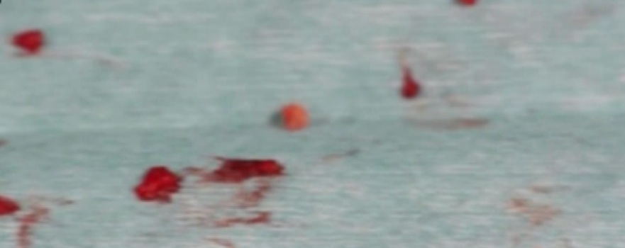 Medicii i-au scos din fata 40-50 de picaturi de bioalcamida cristalizata, care ii migrasera prin tot tesutul