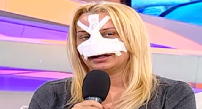 Simona a mai suferit doua operatii la nas pana acum