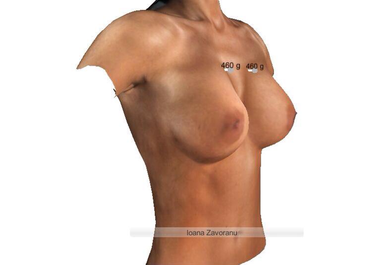 Zavo vrea de aceasta data implanturi de 460 ml