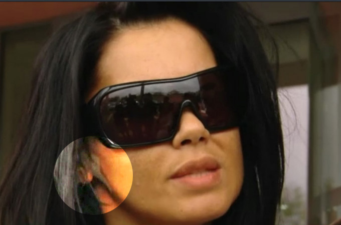 Oana a incercat sa mascheze interventia cu ajutorul unor bandaje