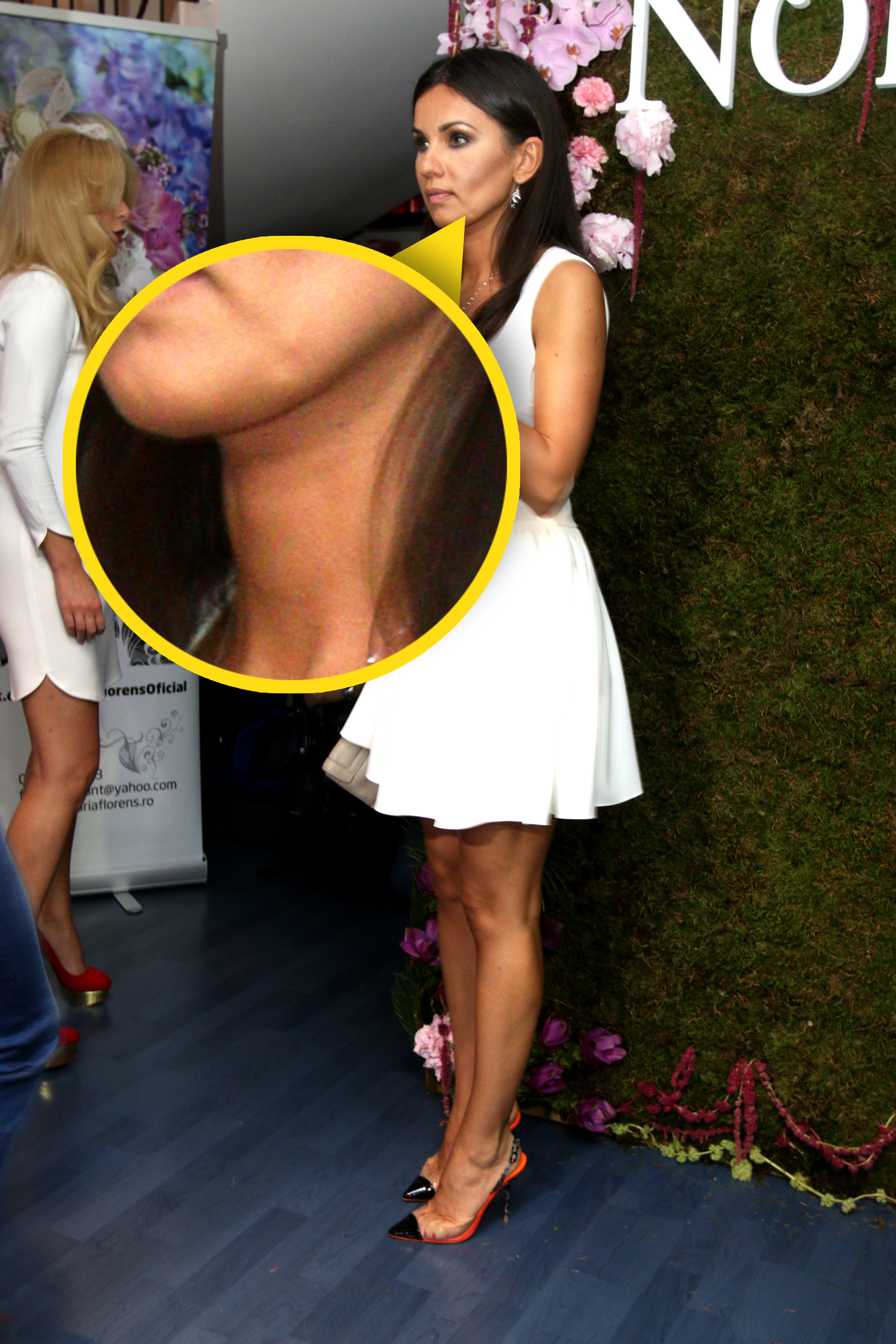 Mirela si-a scos alunita inestetica de pe fata