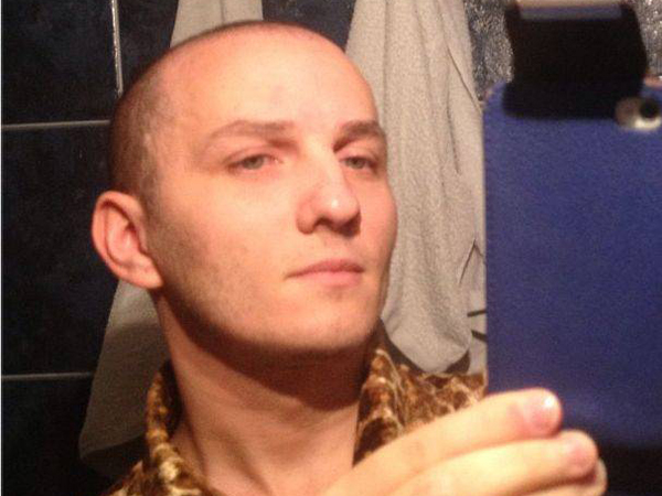 Mihai a apelat la implanturi de par pentru a rezolva problema parului