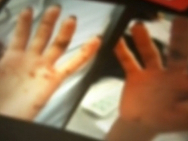 Asa aratau palmele Dianei, cand a iesit din spital