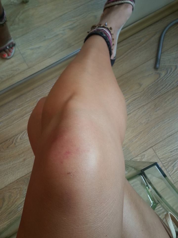 Adina a ramas cu rani vizibile pe picioare, dupa un antrenament