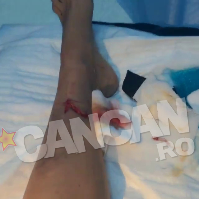 Bianca s-a ranit foarte grav la picior si a ajuns de urgenta la spital