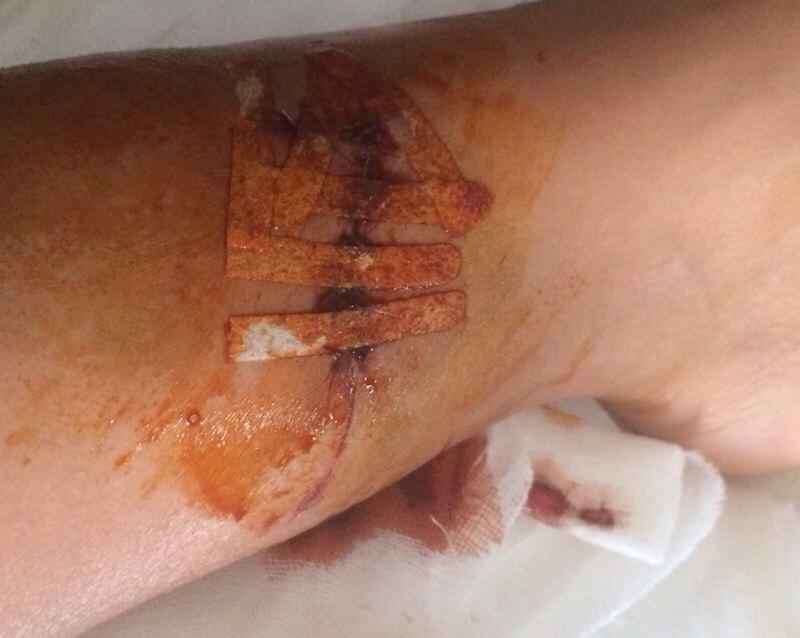 Asa arata piciorul Biancai dupa operatie