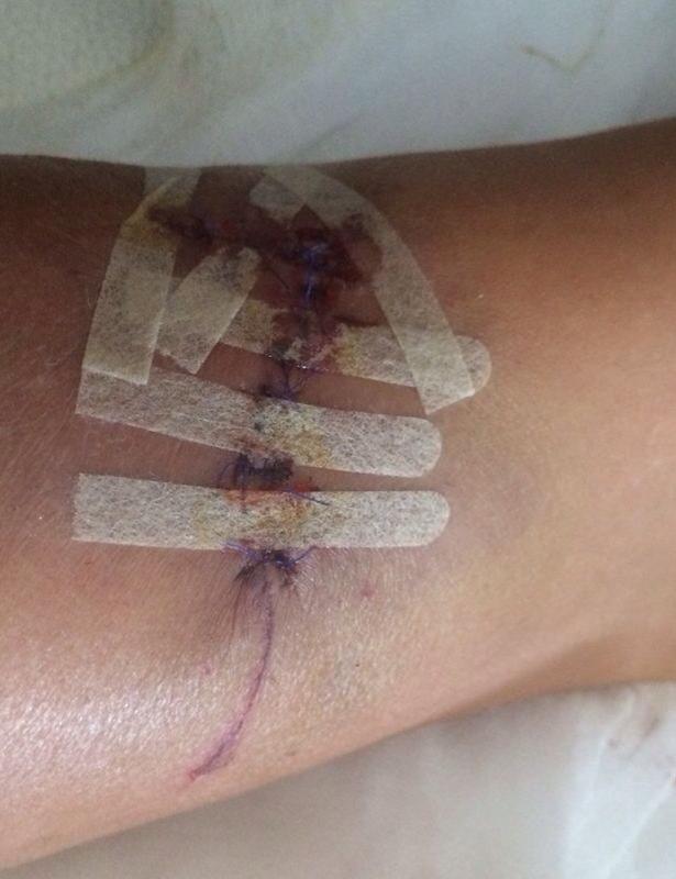 Medicii i-au cusut rana si probabil ca in loc va ramane o cicatrice urata