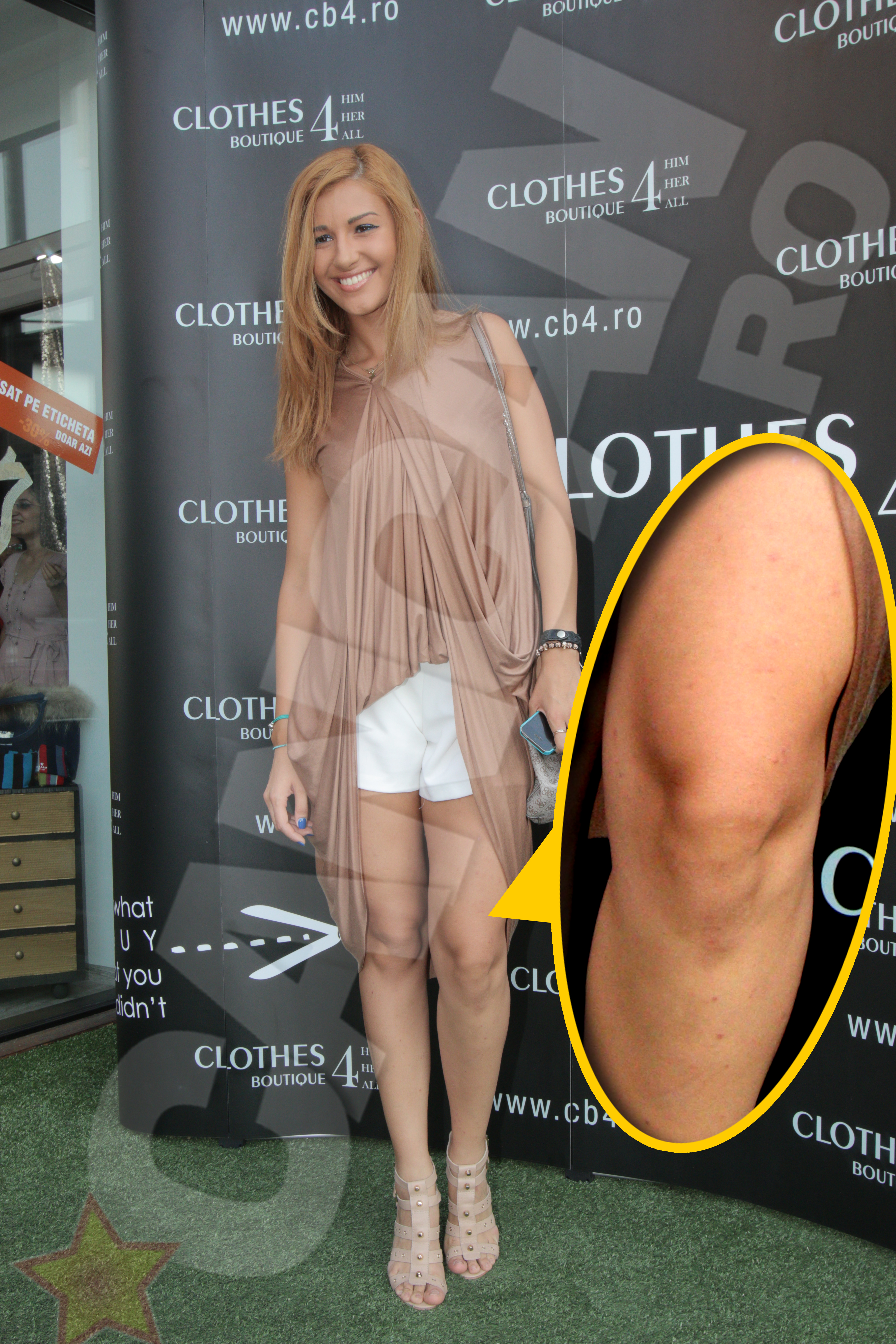 Tinuta pe care a ales-o Alina a lasat la vedere bubele de pe picioare