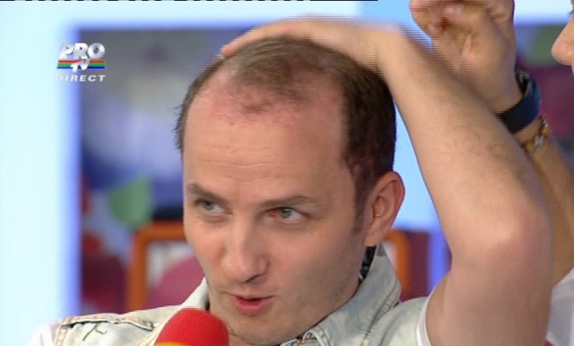 Asa arata Mihai inainte de implantul de par care i-a schimbat viata