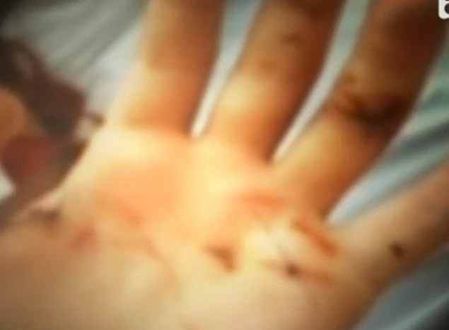 Asa aratau palmele Dianei, dupa ce a fost atacata