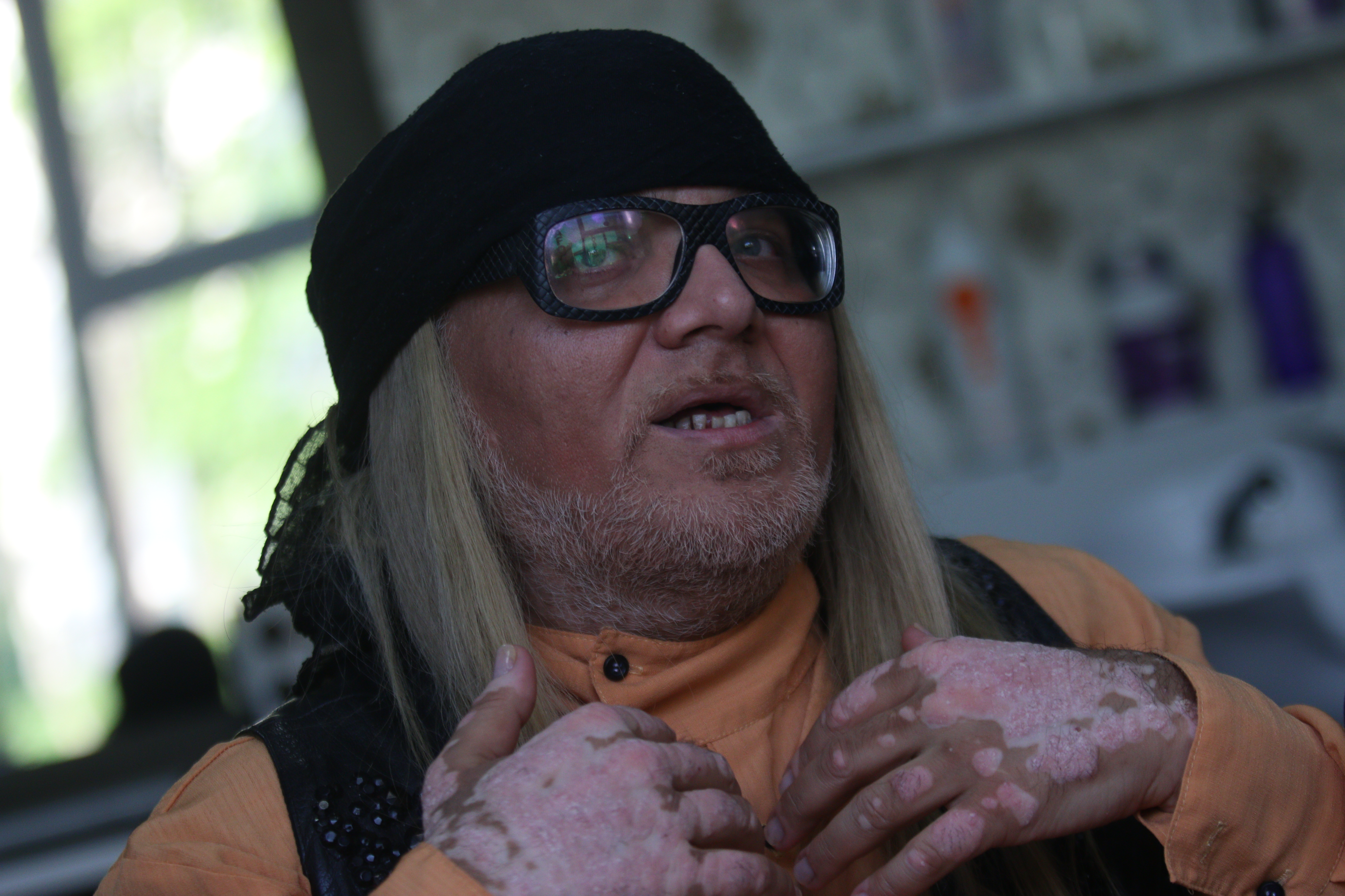 Marian Darta sufera de ani buni si de o boala de piele