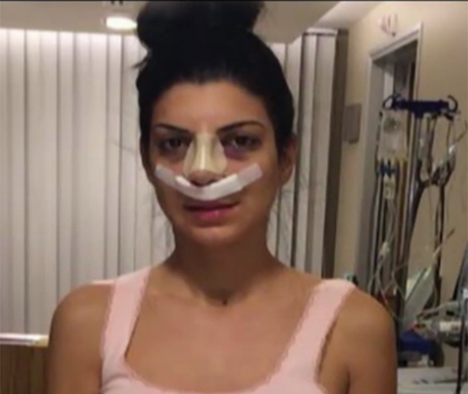 Bruneta este foarte incantata de noul ei nas