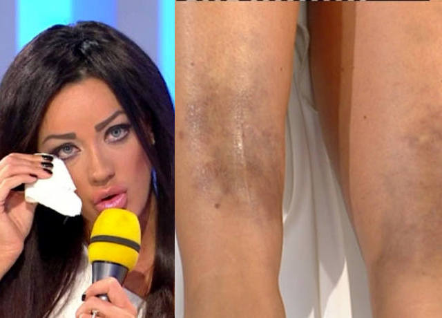 Asa arata piciorul Biancai in vara anului 2013