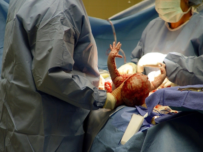 Operatia de cezariana creste cu 35% riscul de autism in randul copiilor