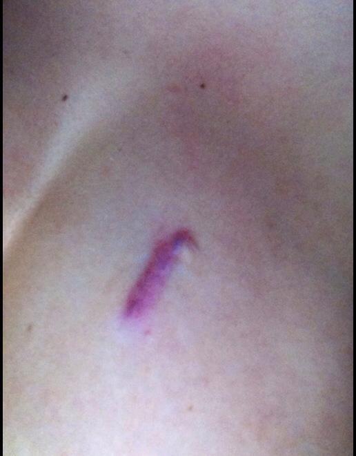 Asa arata acum cicatricea de pe sanul Dianei Enache