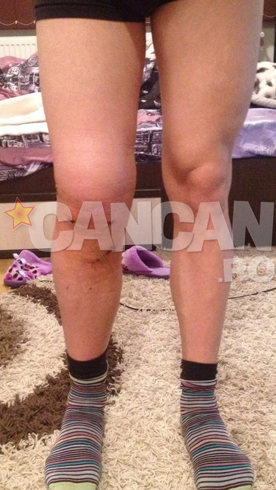 Piciorul lui Stefan Rebeja dupa operatie