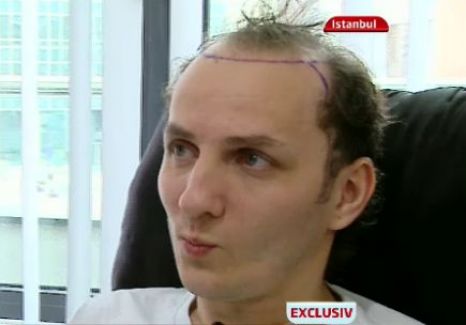 Artistul si-a facut implant de par