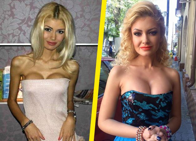 În 2013 (foto stânga) Flavia cântărea doar 35 de kilograme. În prezent viaţa ei s-a schimbat total