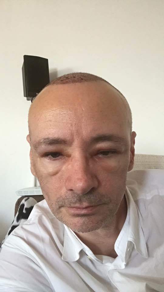 Mihai Albu şi-a făcut implant de păr.