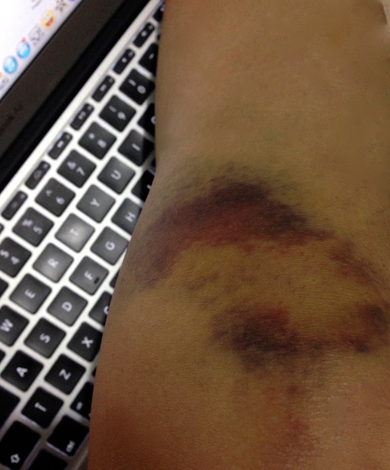 Barbie de România s-a accidentat la picior