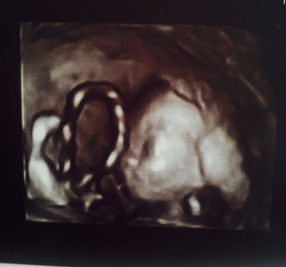 Ecografia cu viitoarea fetiţă a Biancăi Roman